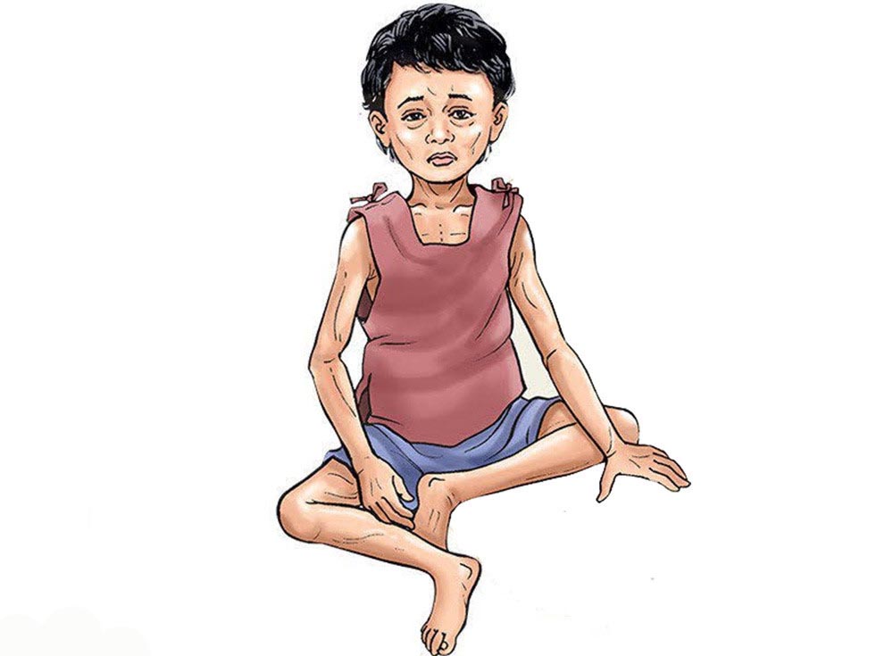 कुपोषणका कारण कर्णालीका बालबालिकाको मृत्यु हुने क्रम बढ्दो 